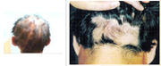 Alopecia Areata treatment in Melbourne