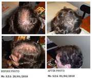 Natural Hair loss treatments in Melbourne