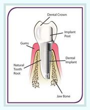 Dental Implants Treatment in Blackburn at Healthy Smiles