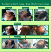 Androgenetic Alopecia Treatment In Melbourne