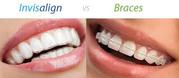 Invisalign Braces - Invisalign Orthodontics Treatment | Healthy Smiles