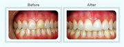 Smile Designing and Smile Makeover Treatment by Healthy Smiles