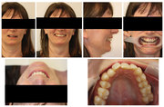 Digital Smile Design Treatment in Melbourne by Healthy Smiles