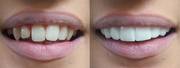 Best Treatment For Porcelain Veneers in Melbourne