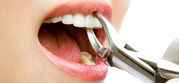 Get Best Wisdom Teeth Removal Treatment by Expert Ballarat Dental Care