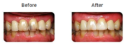 Teeth Bonding and White Fillings Treatment in Melbourne by Healthy Smi