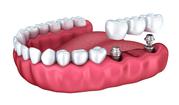 Best Dental Implants Service Melbourne