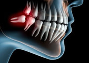 Best Clinic For Wisdom Teeth Removal in Melbourne