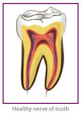 Root Canal Treatment in Blackburn by Healthy Smiles