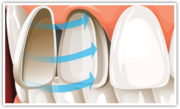 Dental Veneers Melbourne by Captivate Dental
