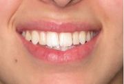 Dental implants Richmond