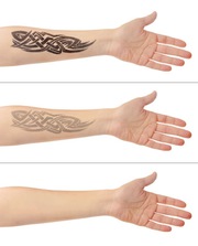 City Of Ink - Laser Tattoo Removal Melbourne