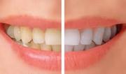 Tooth Whitening - BEDC
