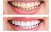  Best Teeth Whitening Clinic - BEDC