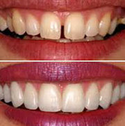 Most Effective Dental Veneers for Your Teeth