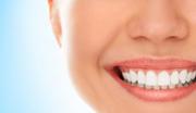 Affordable teeth whitening - BEDC