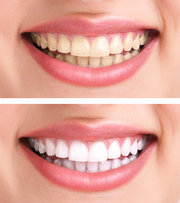 Consider Porcelain Veneers In Caulfield to Improve Your Overall Perfor